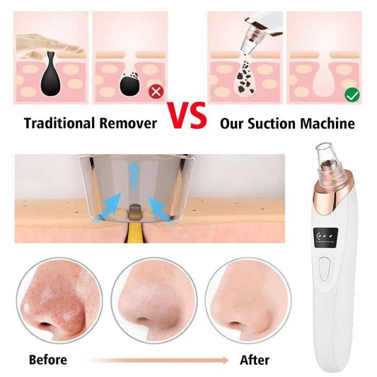 Digital Blackhead Remover Vacuum – Electric Pore Cleaner & Acne Remover Facial Too